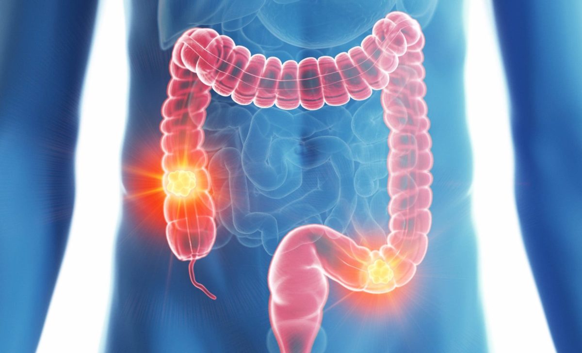 The 5 colon cancer warning signs you should know | Cabot Health