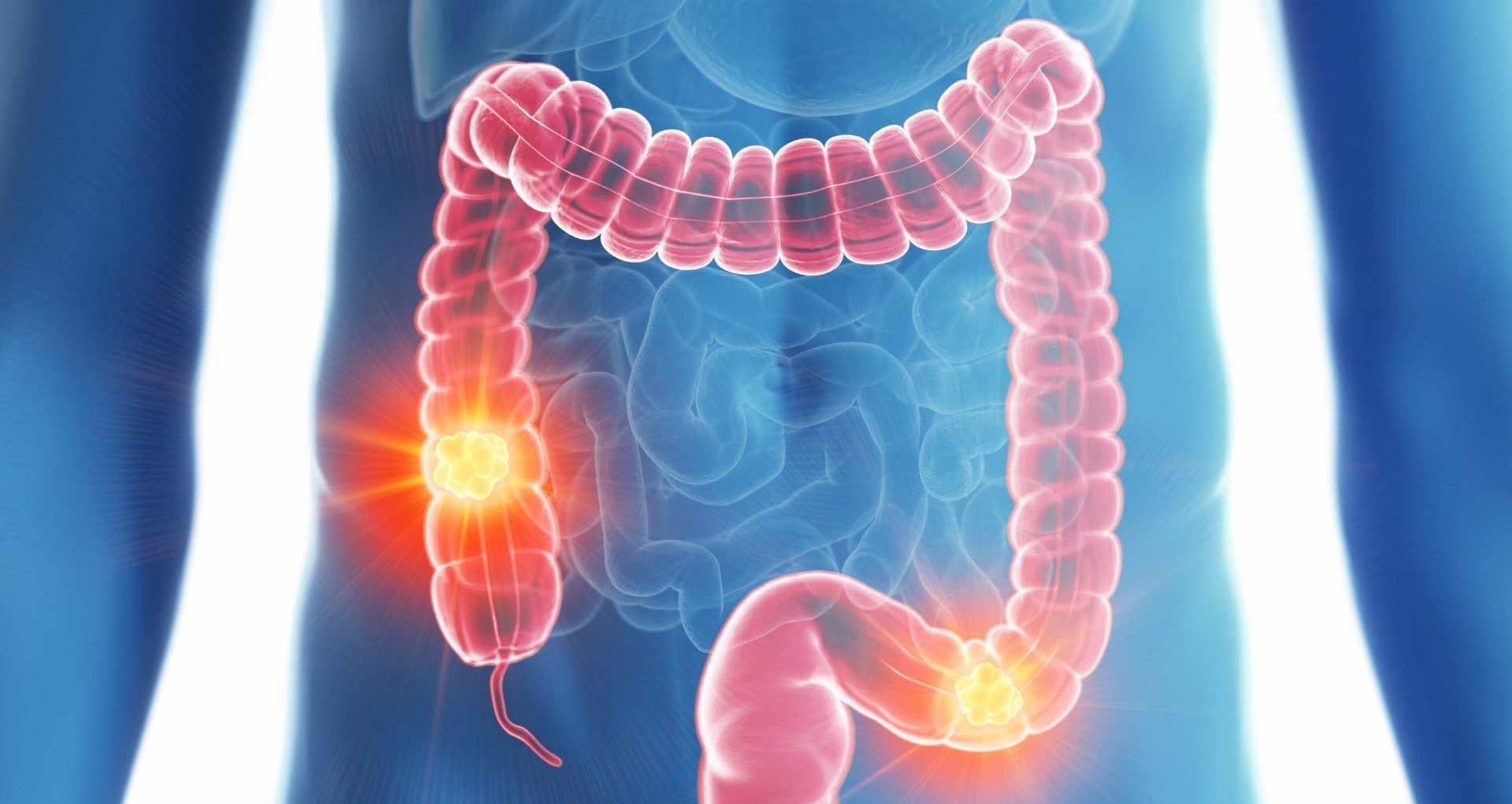 Colon. Colon Cancer спасибо за внимание.